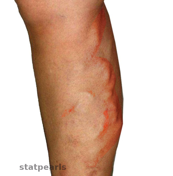 Migratory thrombophlebitis