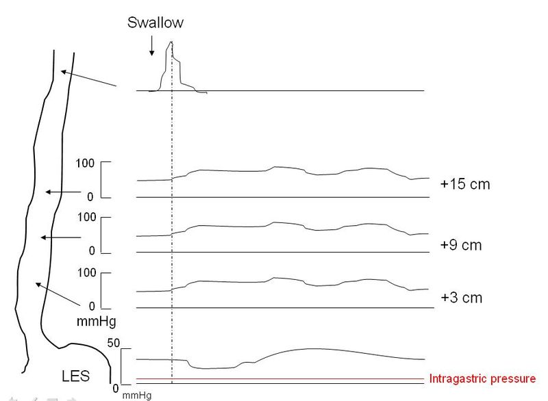 Achalasia manometry