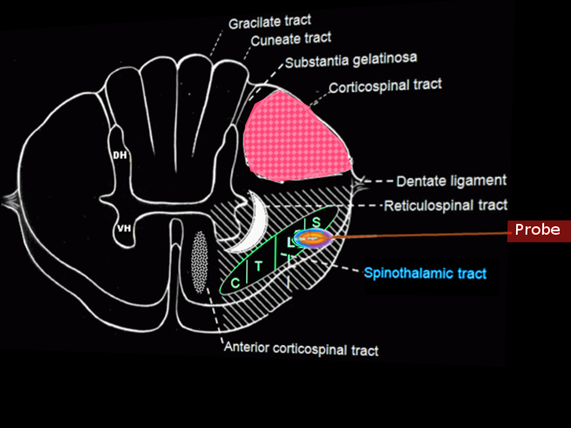 Percutaneous cordotomy