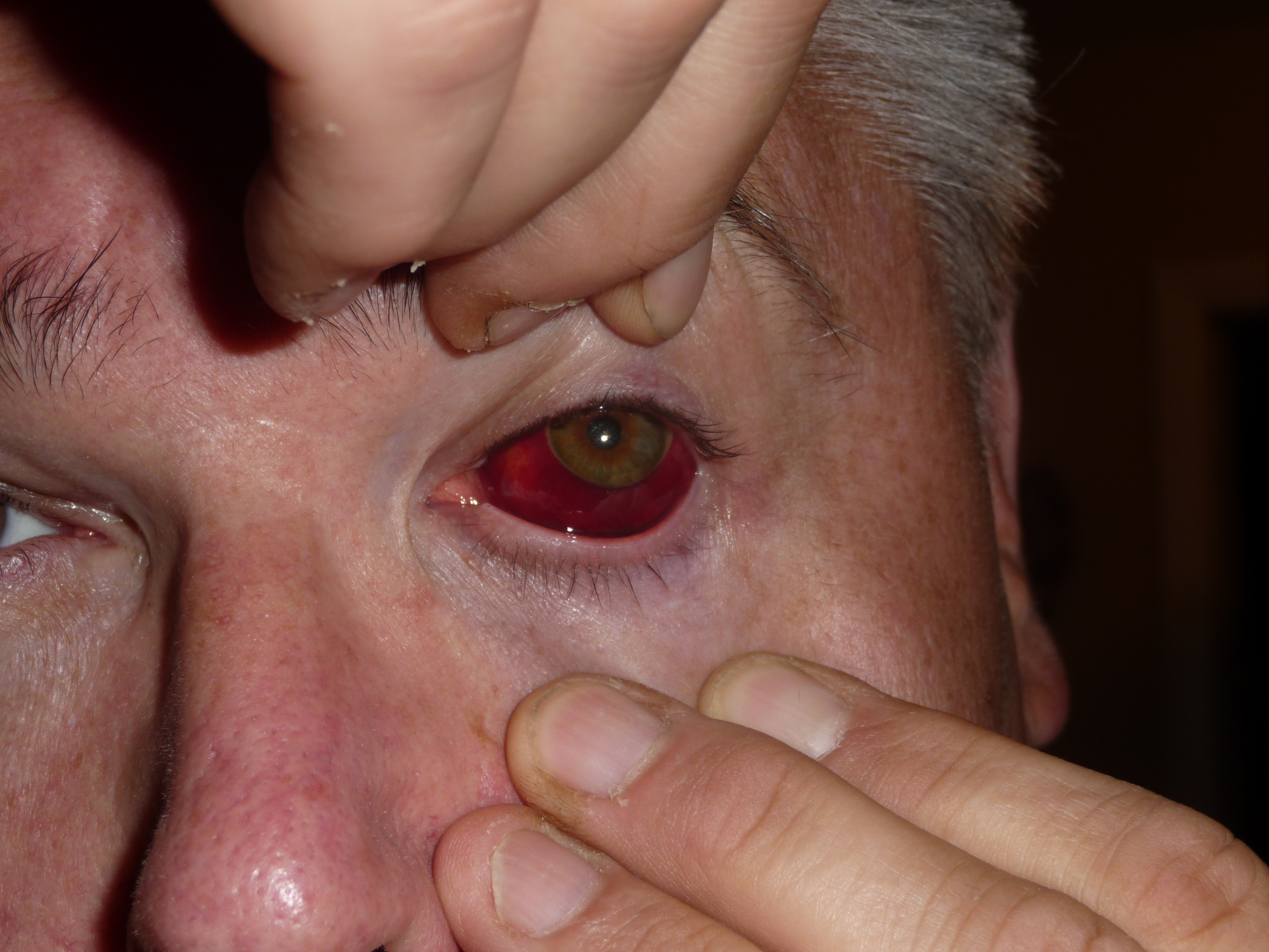 Subconjunctival hemorrhage in anticoagulated patient