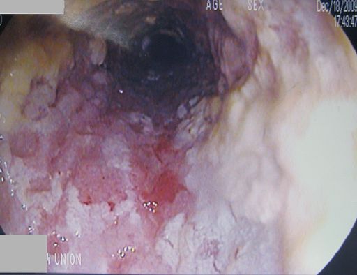 Esophageal Candidiasis