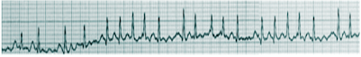 Atrial fibrillation