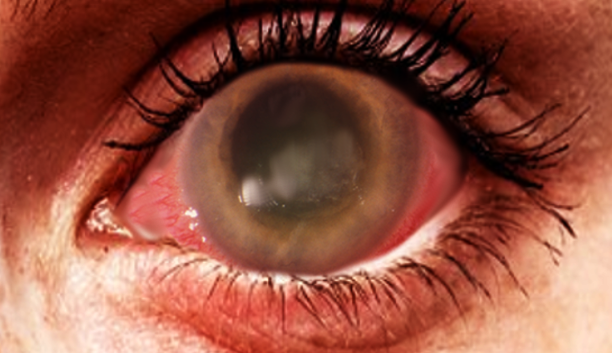 Acanthamoeba keratitis