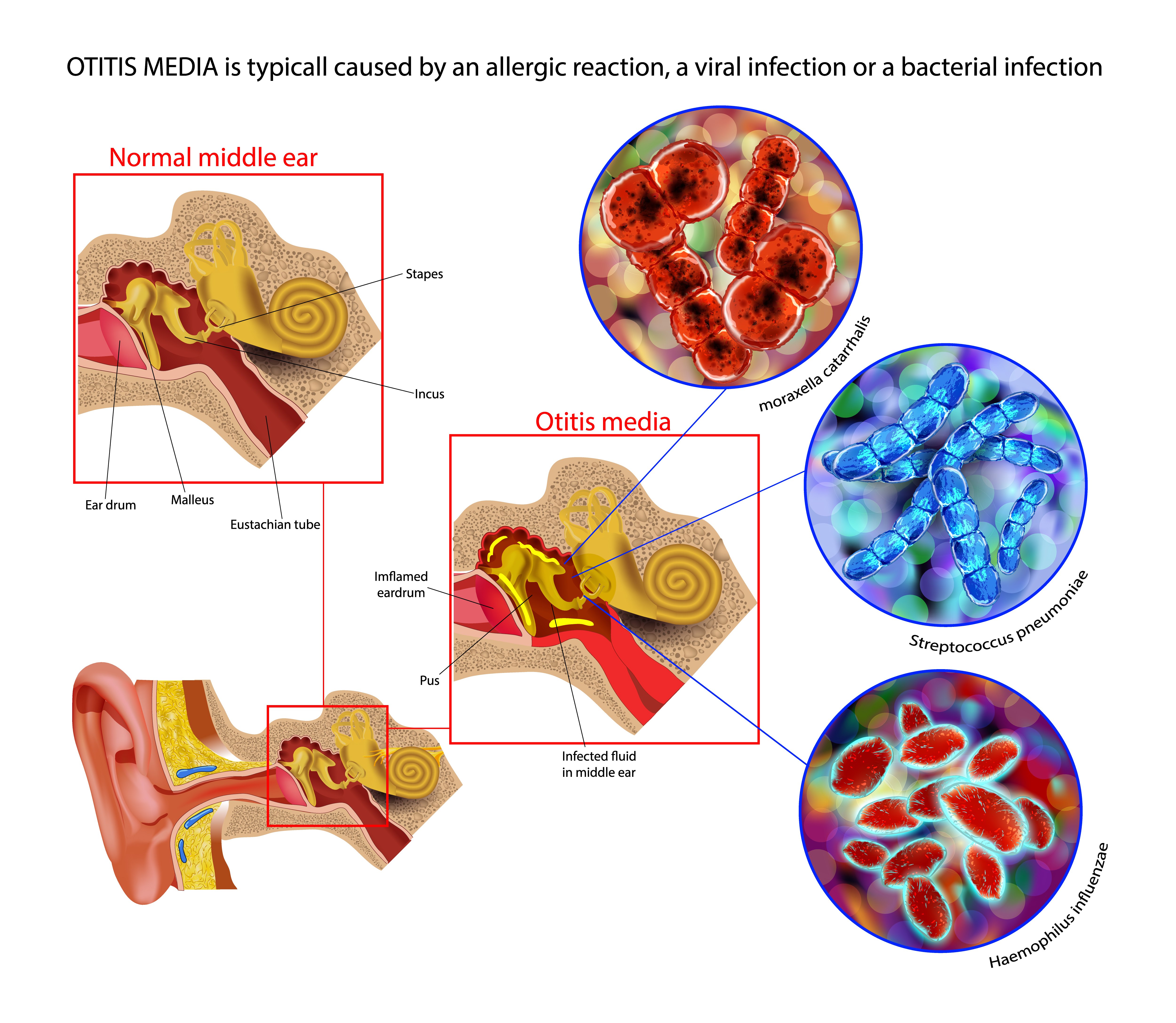 Acute Otitis Media