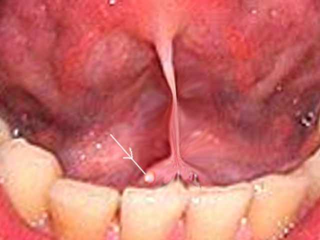 Submandibular stone