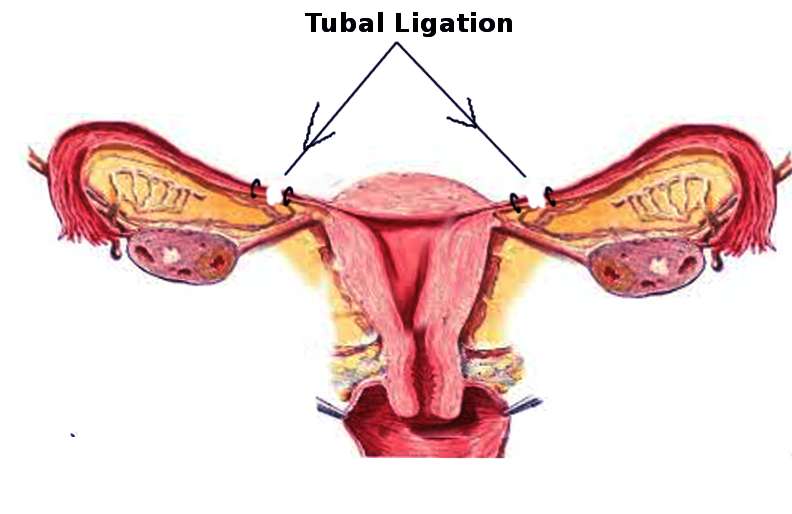 Tubal ligation