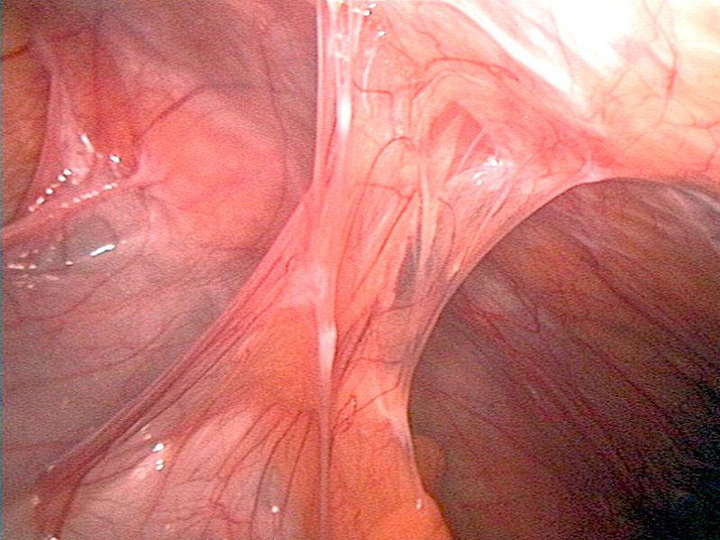 Adhesions to the abdominal wall