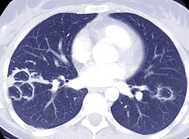 <p>Chest CT of <em>Mycobacterium Abscessus</em></p>