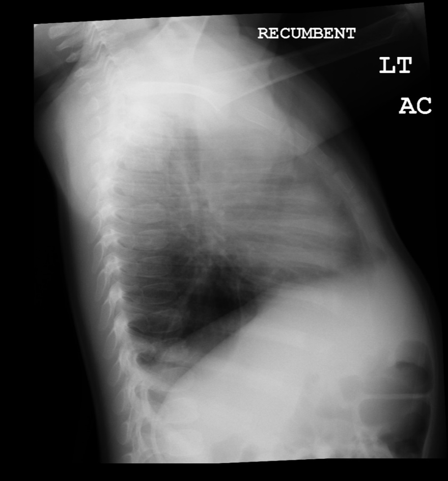 Lateral view of chest radiograph showing left lower lobe CPAM