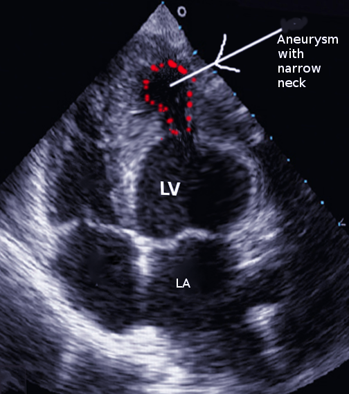 <p>Left Ventricular Aneurysm, Ultrasound. This image shows a left ventricular aneurysm on Doppler ultrasound.</p>