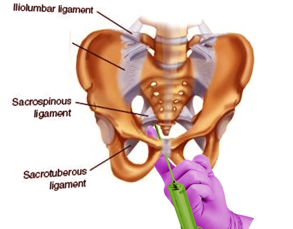 Pudendal nerve block