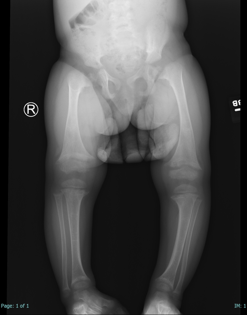 Single AP view from a leg alignment study demonstrates metaphyseal flaring (widening) of the distal femurs as well as proximal and distal tibial metaphyses