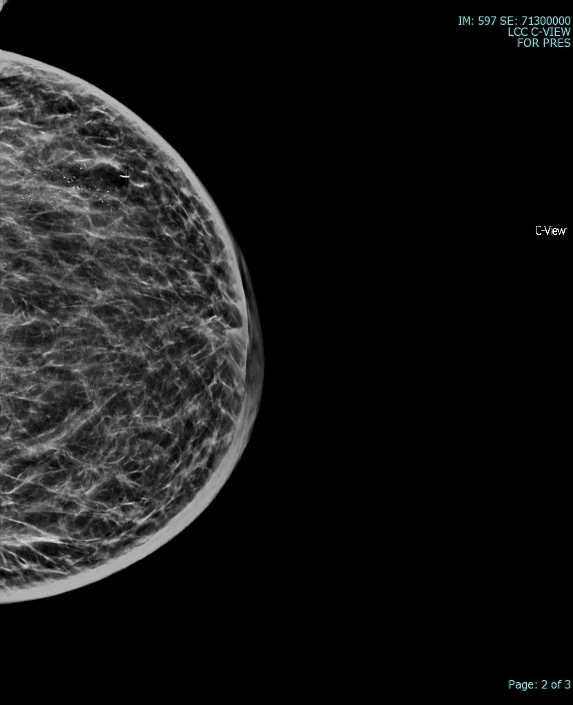 CC mammographic view of the left breast demonstrates skin thickening, trabecular coasrening/diffusely increased breast density and malignant type calcifications in this patient with biopsy proven inflammatory breast cancer