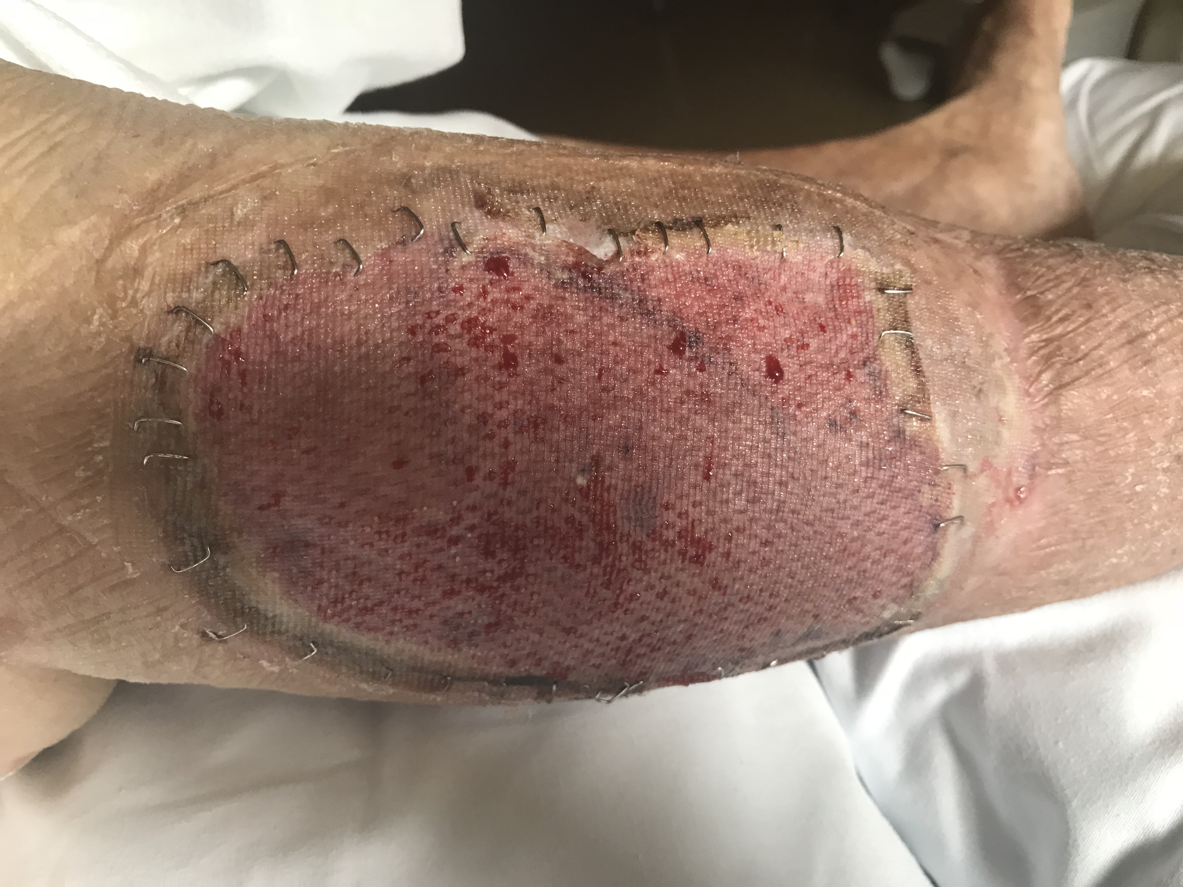 Split-thickness skin graft to right lower leg