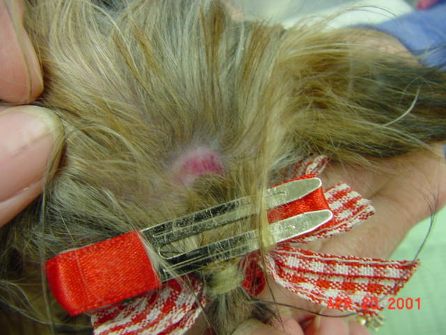 Traction alopecia