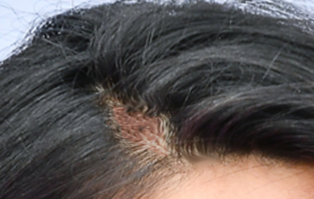 Traction alopecia