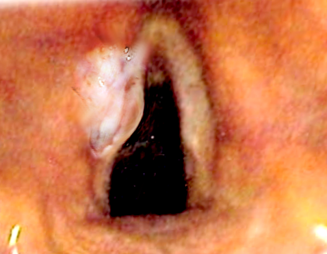 Laryngeal cancer