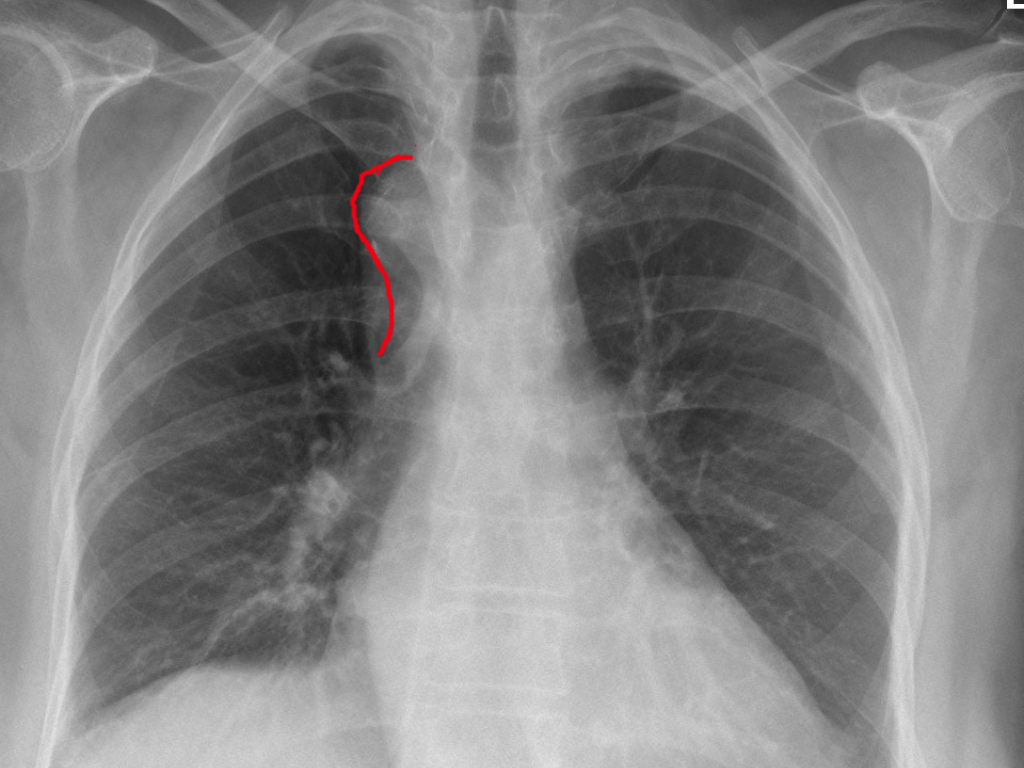 Right aortic arch