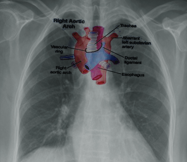 Right aortic arch