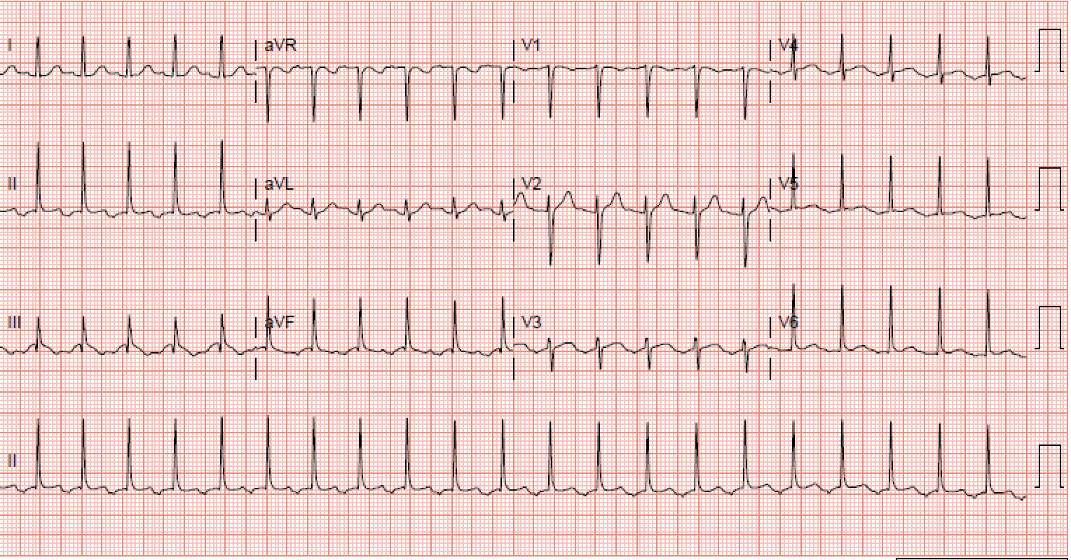 This is a rhythm strip of uncommon AVNRT.