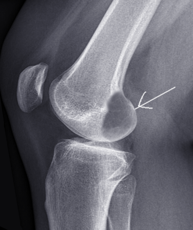 Osteoclastoma (GCTB)