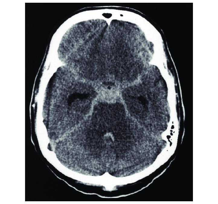 STAR sign subarachnoid hemorrhage