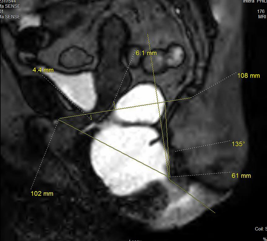 This sagitall image from MR Defecography shows severe perineal descent syndrome involving the posterior compartment