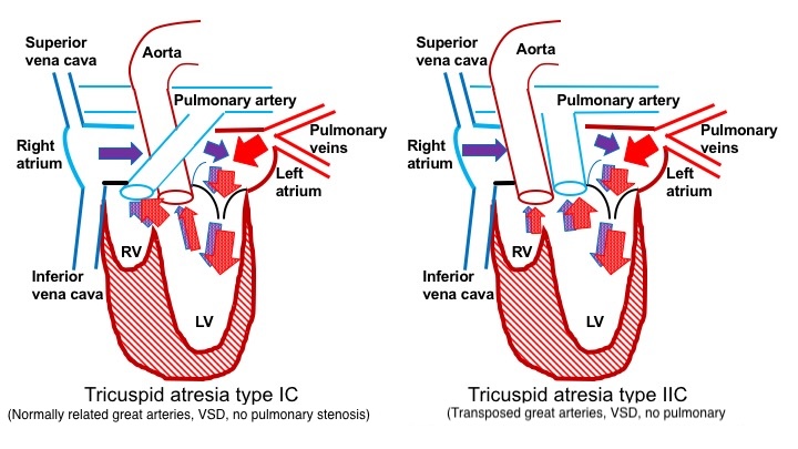 The flow of blood through the heart in patients without pulmonary obstruction