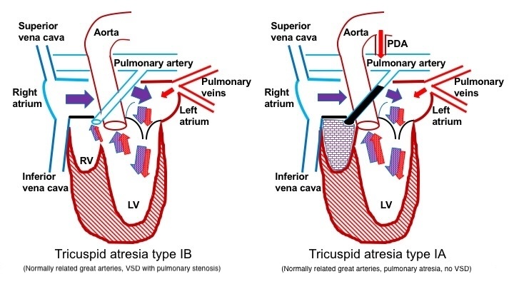 The flow of blood through the heart in patients with pulmonary obstruction