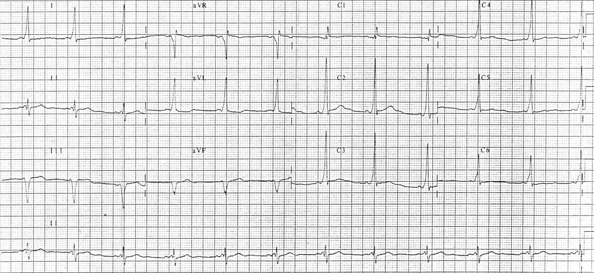 EKG showing WPW syndrome