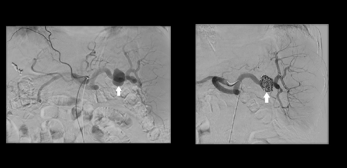 Digital subtraction angiography shows a splenic artery aneurysm before (left arrow) and after coil embolization (right arrow)