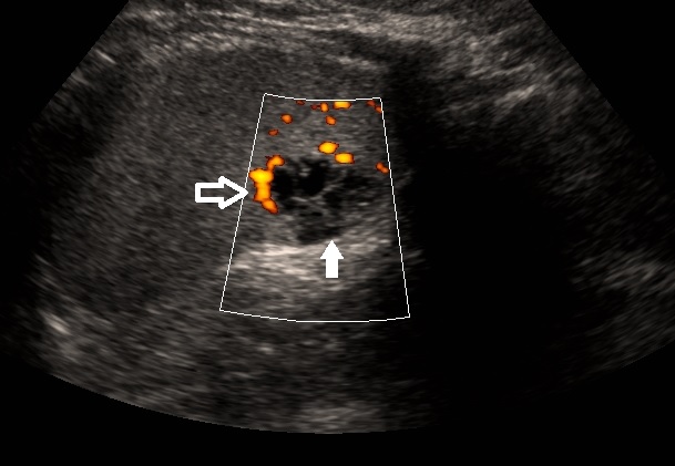 Ultrasound of the spleen in sagittal plane demonstrates a multilocular cystic structure in the periphery of the spleen (solid white arrow)