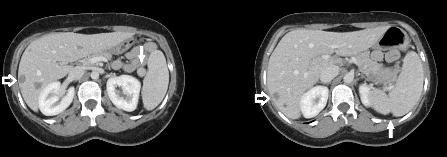 Axial slice from a CT of the upper abdomen (left) demonstrates a small mass at the splenic hilum with similar attenuation to the nearby spleen consistent with a splenule (solid arrow)