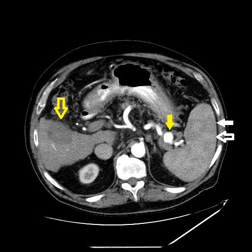 Axial slice of a contrast-enhanced CT of the upper abdomen in the arterial phase shows heterogeneous splenic enhancement