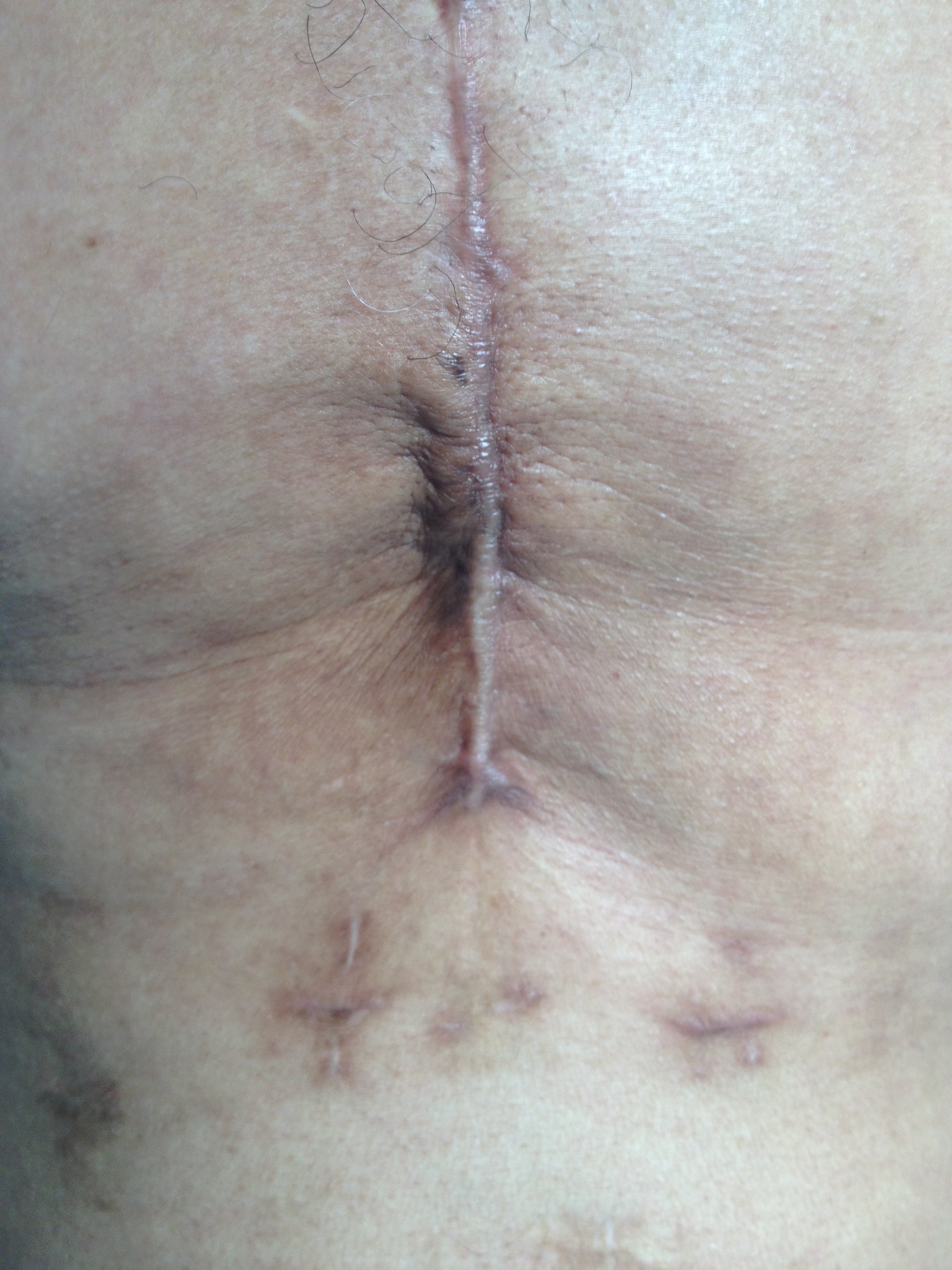 The photo shows a previous sternotomy; the wound has healed and is not infected, but shows a possible evolution in a hypertrophic scar