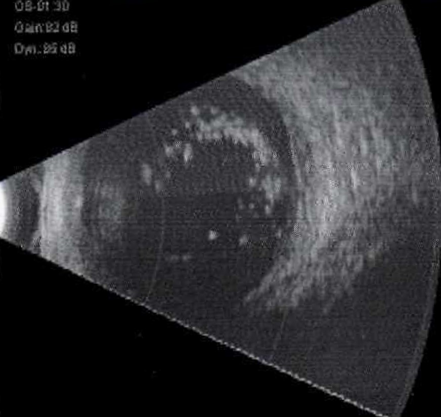 Ultrasound B-Scan image of an eye with asteroid hyalosis