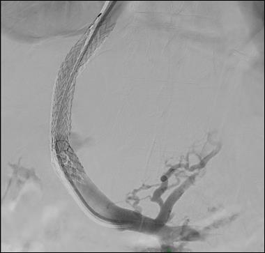 portal venogram through TIPS showing esophageal varices