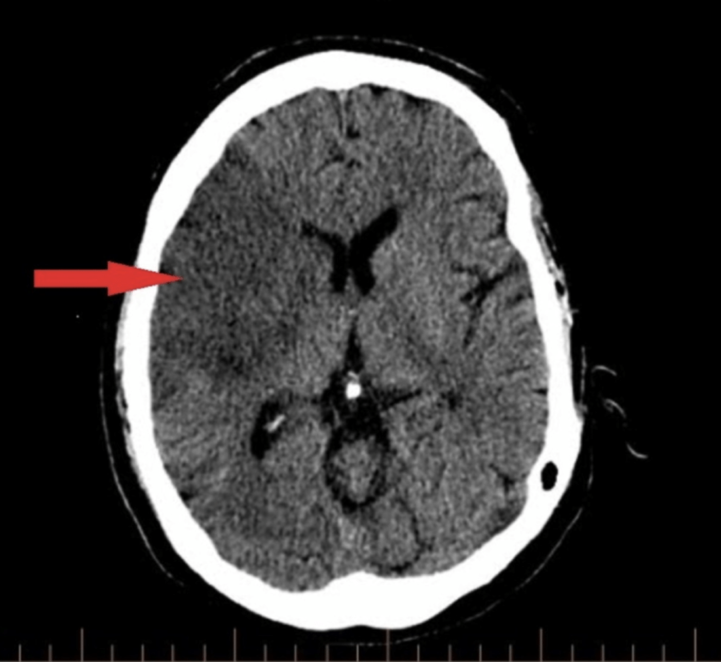 Right MCA stroke