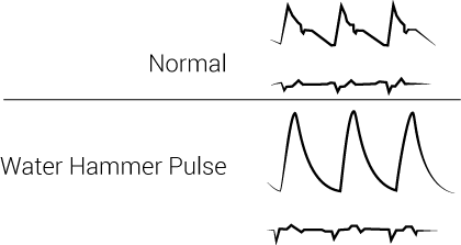 Collapsing Pulse or Water Hammer Pulse