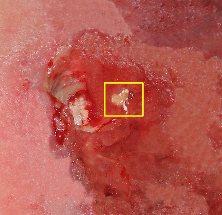 Photo of pressure ulcer with ischium protruding