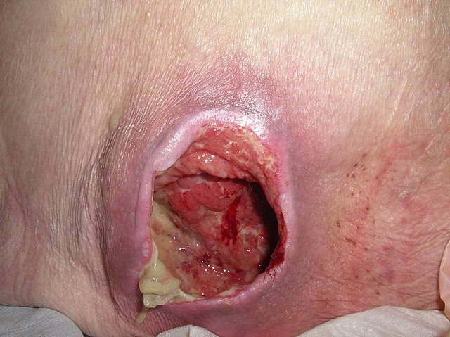 Close up shot of Stage 4 Ulcer