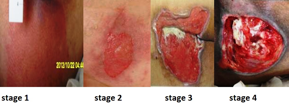 Stages of Ulcers