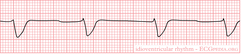 Rhythm idioventricular