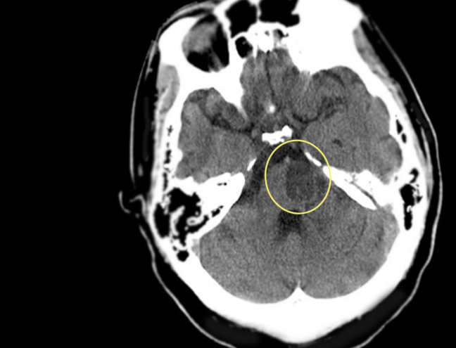 Pontine infarction