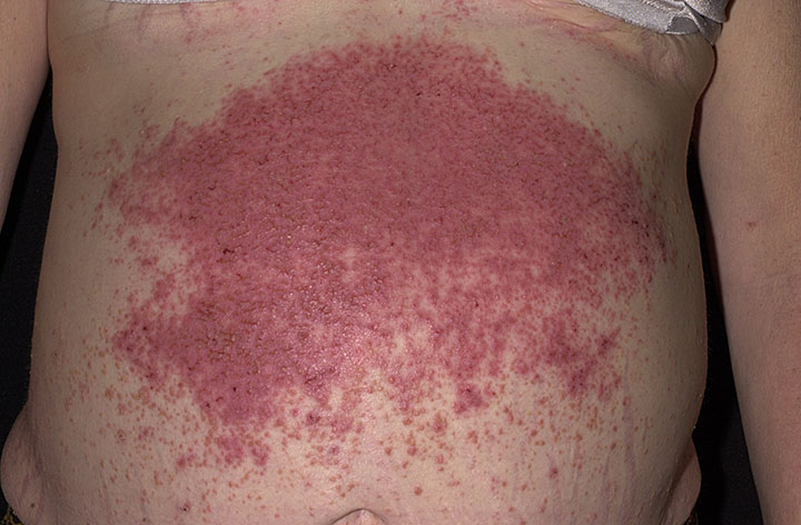 Dermatitis herpetiformis