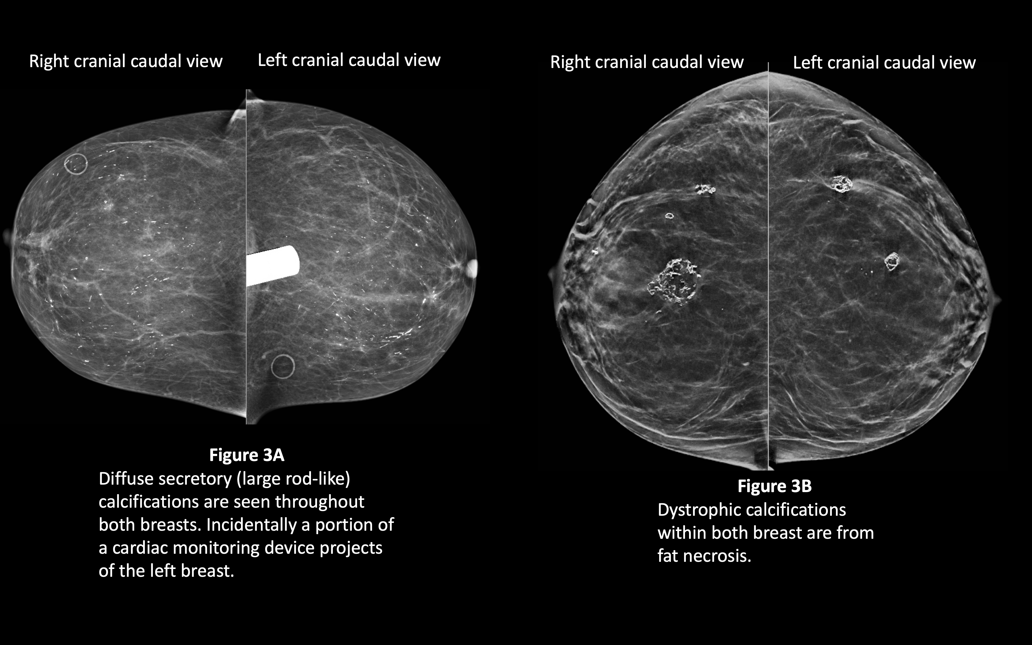 secretory and dystrophic calcifications