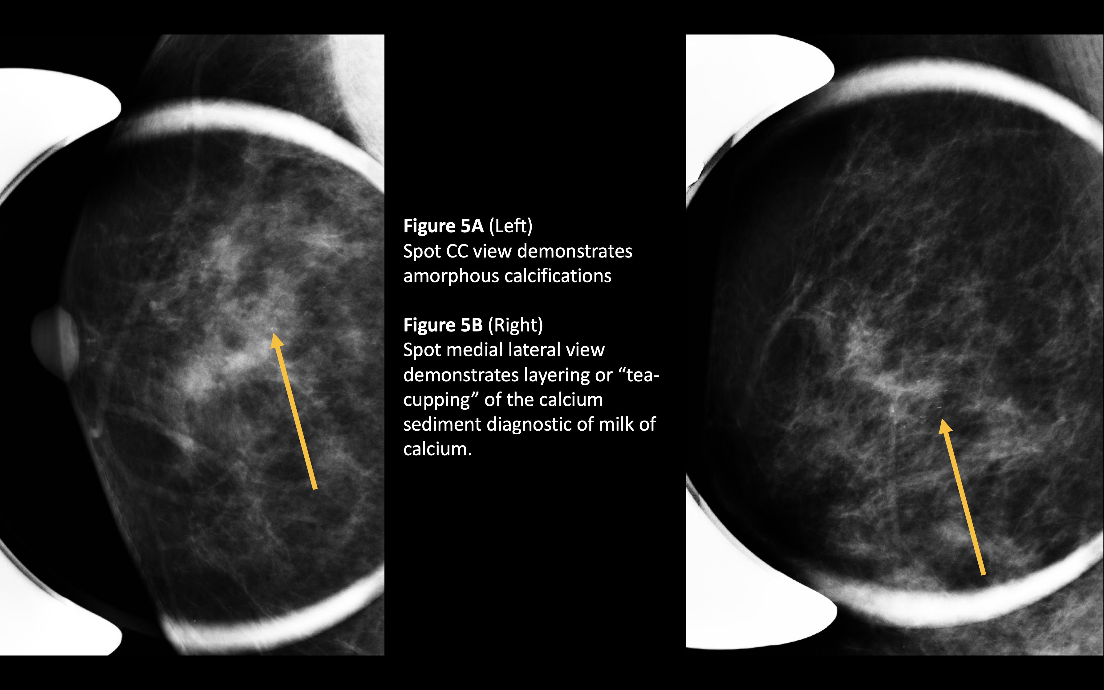 milk of calcium calcifications