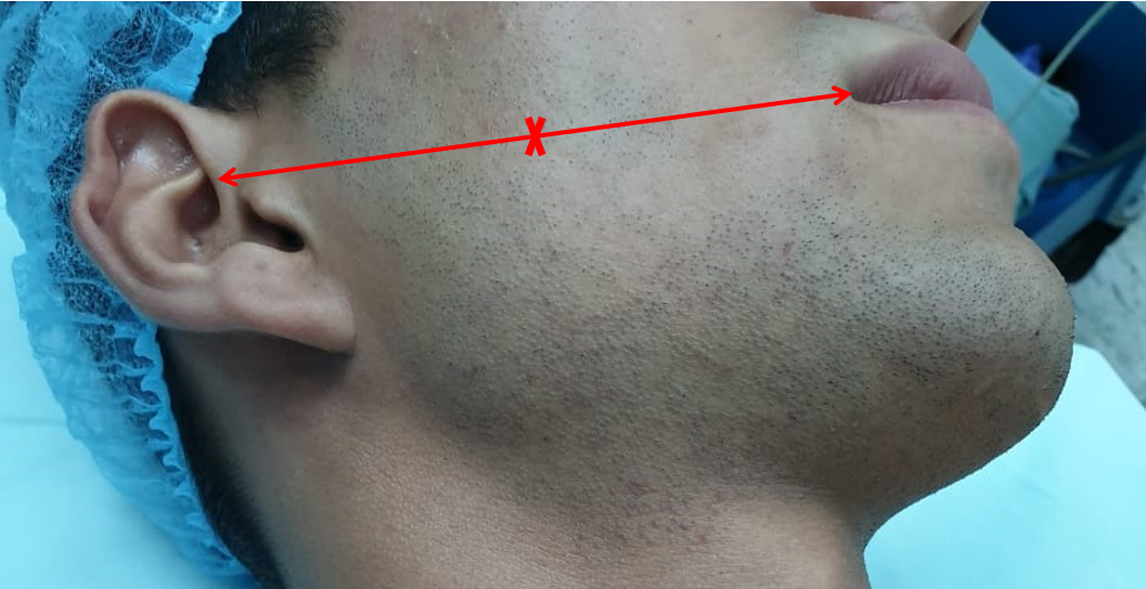 <p>Course of the Facial Nerve