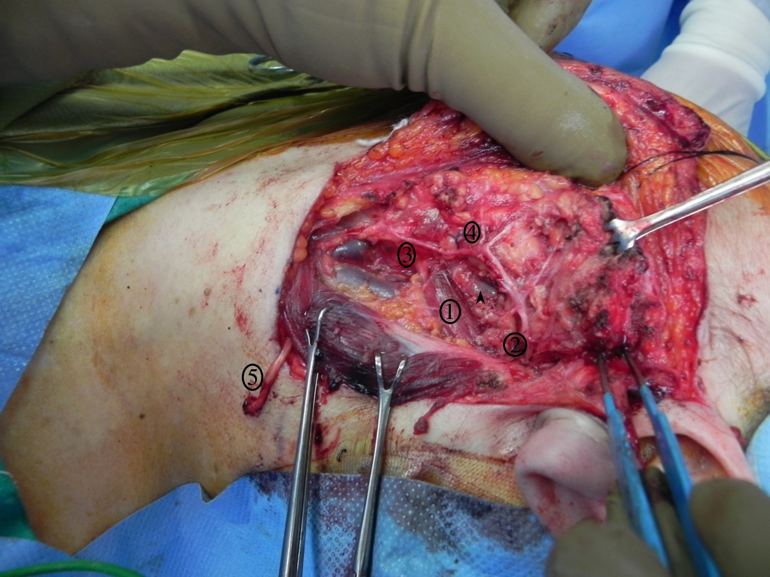 Superficial parotidectomy for a benign salivary gland tumor