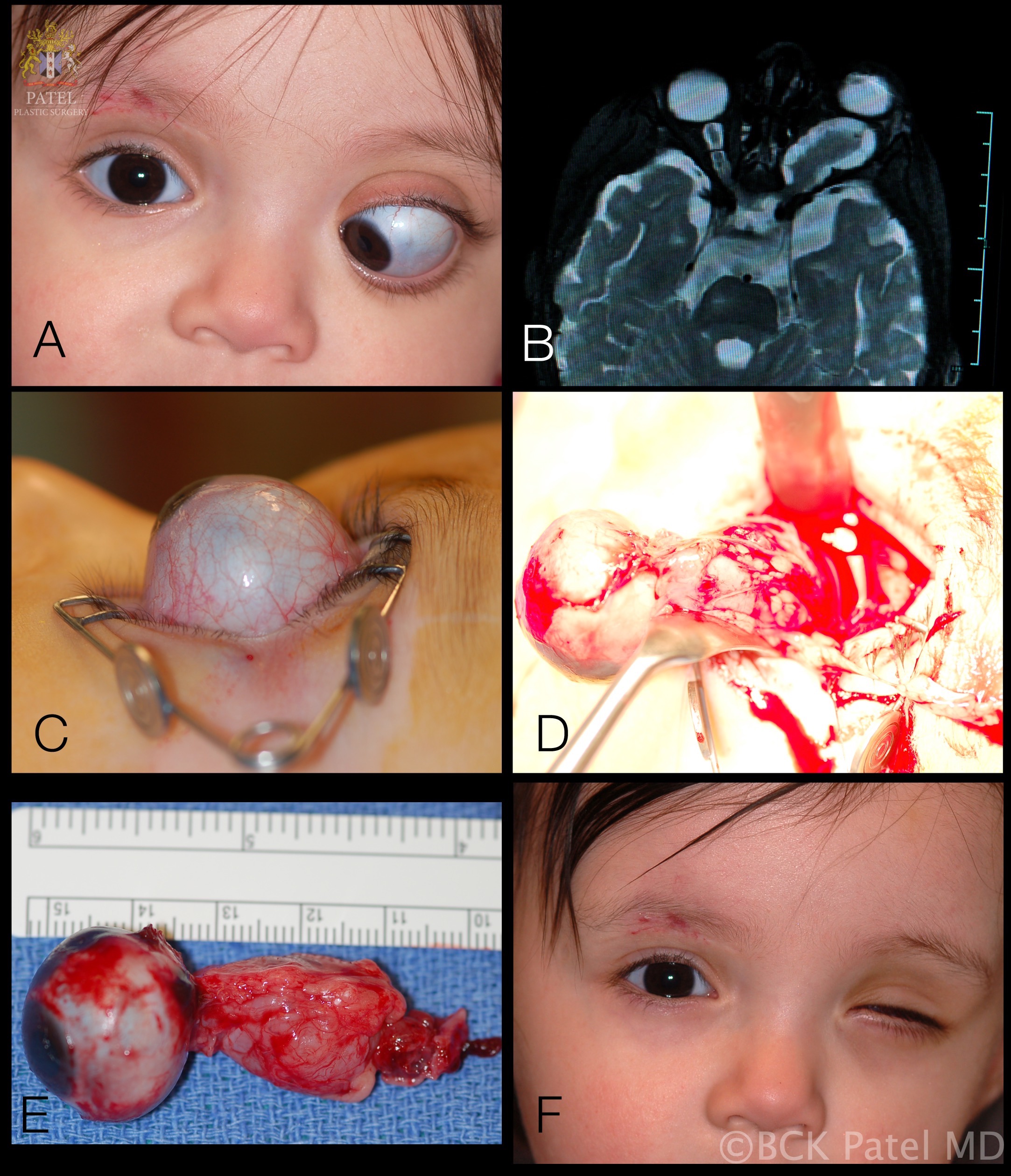 Left optic nerve glioma